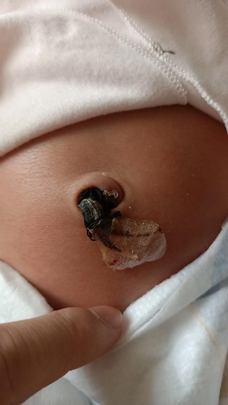 新生儿脐带到底需要多久才能脱落？家长该如何正确护理促进愈合？-第3张图片-郑州医学网