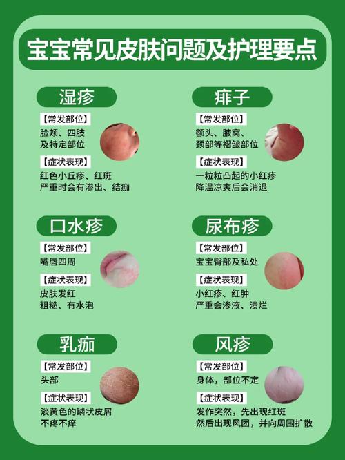 新生儿身上长痱子别慌！这些护理妙招和注意事项新手爸妈必看？-第2张图片-郑州医学网