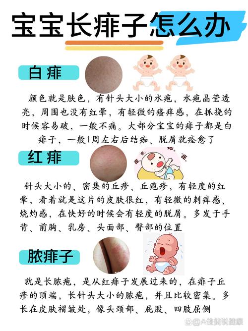 新生儿身上长痱子别慌！这些护理妙招和注意事项新手爸妈必看？-第3张图片-郑州医学网