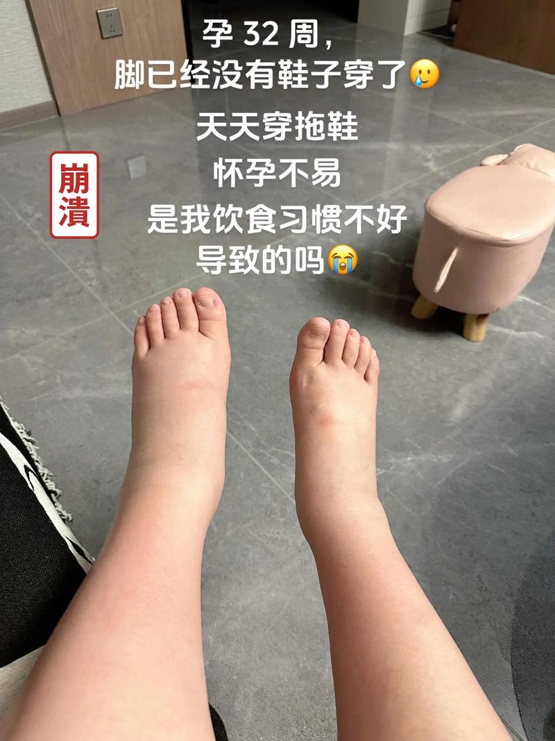 孕期脚浮肿到底能不能泡脚？泡脚会加重水肿还是有缓解作用？-第1张图片-郑州医学网