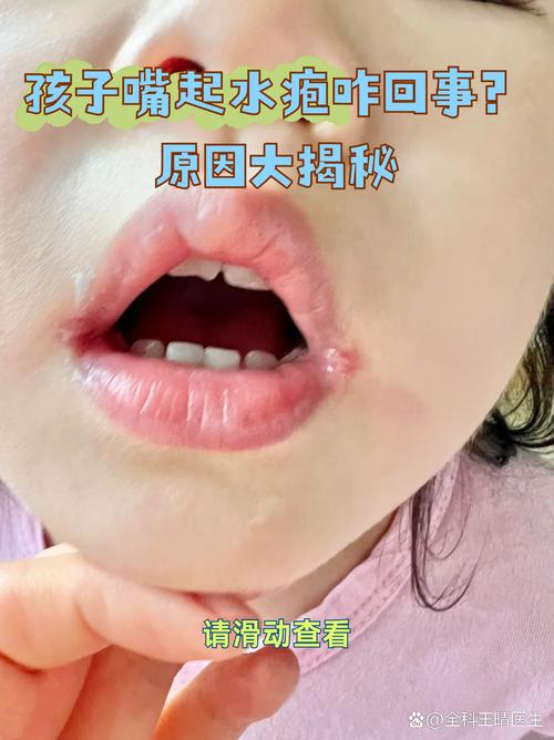 新生儿嘴唇起泡是缺水还是生病?新手爸妈该如何判断与应对?-第1张图片-郑州医学网 新生儿嘴唇起泡是缺水还是生病?新手爸妈该如何判断与应对?-第1张图片-郑州医学网