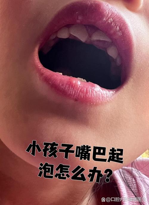 新生儿嘴唇起泡是缺水还是生病?新手爸妈该如何判断与应对?-第3张图片-郑州医学网 新生儿嘴唇起泡是缺水还是生病?新手爸妈该如何判断与应对?-第3张图片-郑州医学网