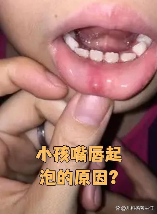 新生儿嘴唇起泡是缺水还是生病？新手爸妈该如何判断与应对？-第2张图片-郑州医学网