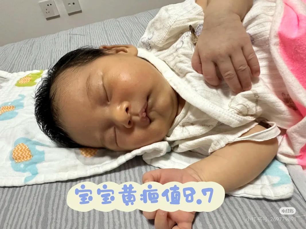 新生儿黄疸20多严重吗？需要照蓝光治疗吗？对宝宝有影响吗？-第3张图片-郑州医学网