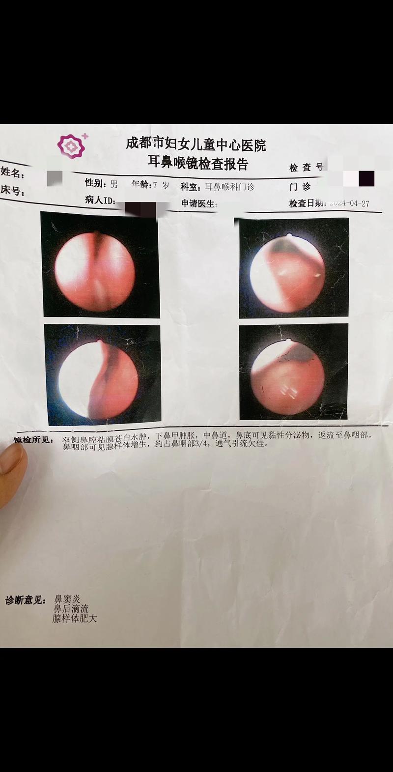 儿童腺样体肥大保守治疗有效吗？有哪些方法？什么情况需要手术？-第3张图片-郑州医学网