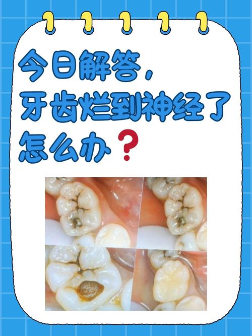 孕期牙髓炎疼得睡不着，到底能不能治？对胎儿有影响吗？-第2张图片-郑州医学网