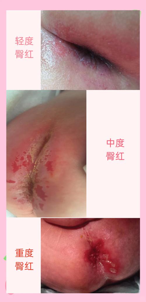 新生儿屁股破皮是红疹还是护理不当?如何辨别原因并正确处理?-第1张图片-郑州医学网 新生儿屁股破皮是红疹还是护理不当?如何辨别原因并正确处理?-第1张图片-郑州医学网