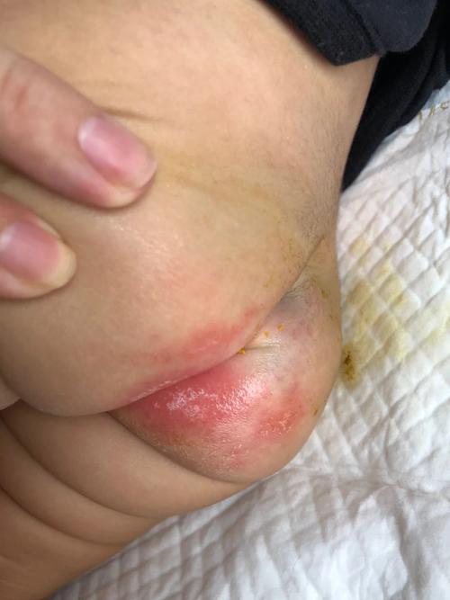 新生儿屁股破皮是红疹还是护理不当?如何辨别原因并正确处理?-第3张图片-郑州医学网 新生儿屁股破皮是红疹还是护理不当?如何辨别原因并正确处理?-第3张图片-郑州医学网