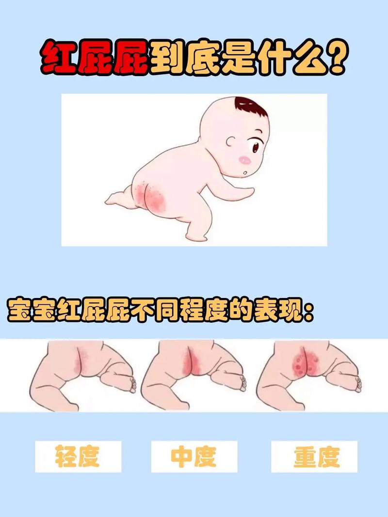 新生儿屁股破皮是红疹还是护理不当?如何辨别原因并正确处理?-第2张图片-郑州医学网 新生儿屁股破皮是红疹还是护理不当?如何辨别原因并正确处理?-第2张图片-郑州医学网