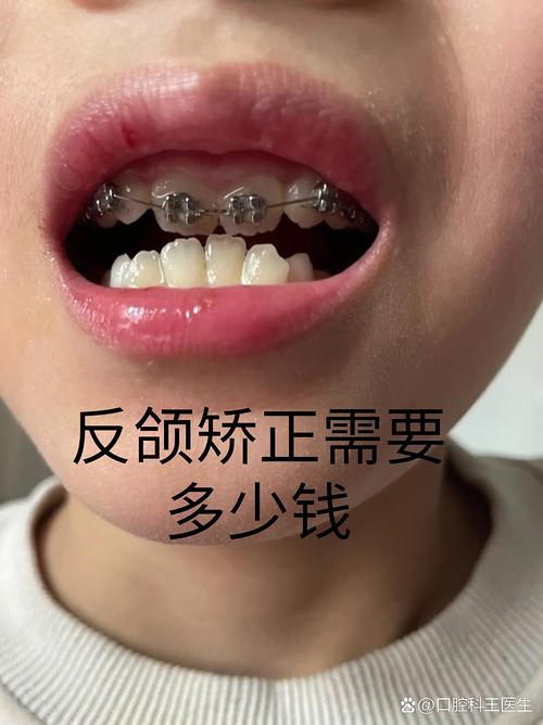 儿童牙齿反颌矫正费用受哪些因素影响？大概需要准备多少预算？-第2张图片-郑州医学网