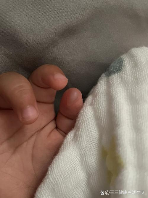 10天新生儿手上长水泡是正常现象吗？需要警惕哪些疾病风险？-第2张图片-郑州医学网