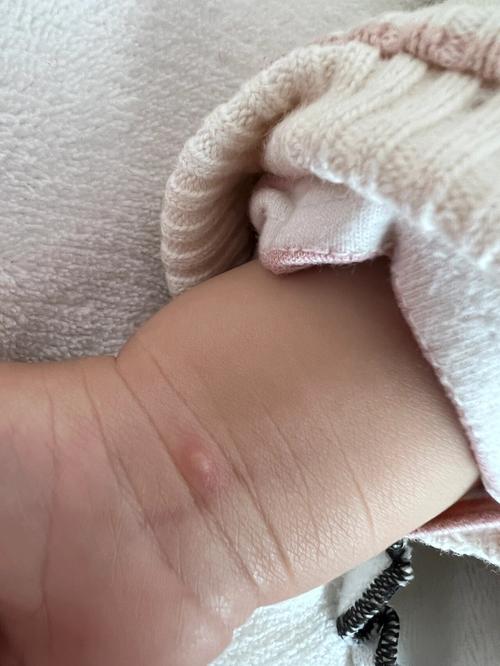 10天新生儿手上长水泡是正常现象吗？需要警惕哪些疾病风险？-第1张图片-郑州医学网