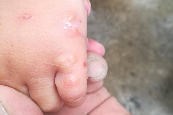 10天新生儿手上长水泡是正常现象吗？需要警惕哪些疾病风险？-第3张图片-郑州医学网