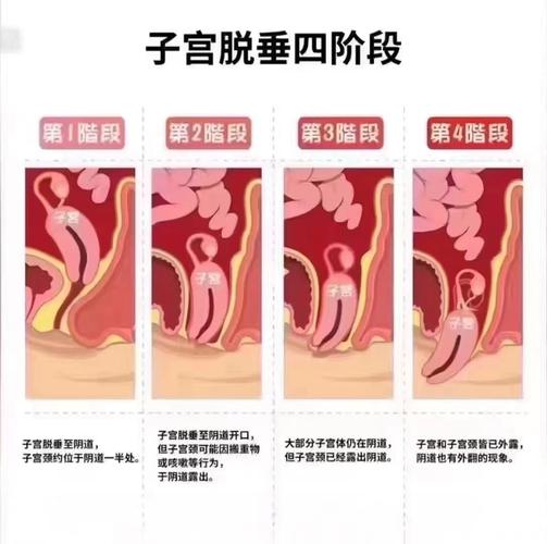 孕期子宫脱垂的幕后推手是谁？激素、胎儿还是盆底肌的锅？-第3张图片-郑州医学网