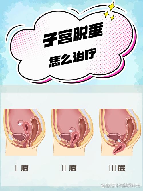 孕期子宫脱垂的幕后推手是谁？激素、胎儿还是盆底肌的锅？-第2张图片-郑州医学网