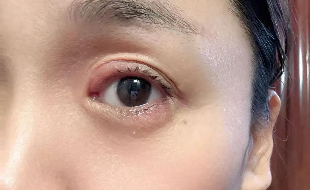 孕期眼睛肿是正常生理反应还是疾病信号?水肿背后隐藏哪些健康隐患?-第2张图片-郑州医学网 孕期眼睛肿是正常生理反应还是疾病信号?水肿背后隐藏哪些健康隐患?-第2张图片-郑州医学网