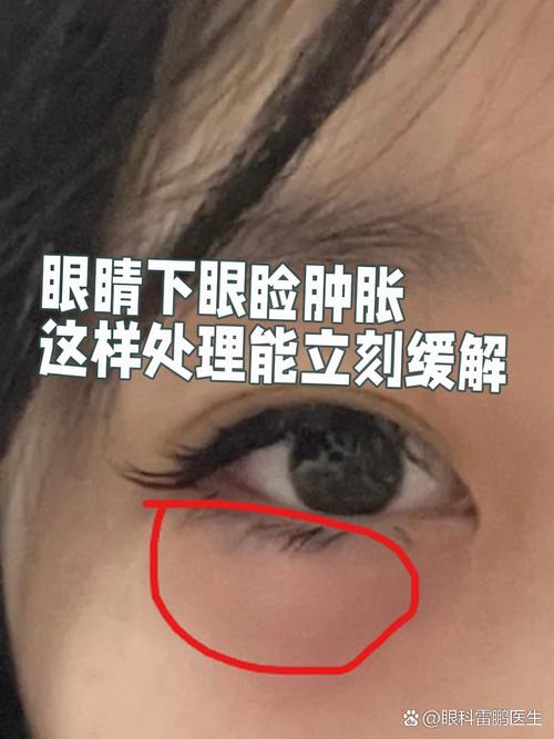 孕期眼睛肿是正常生理反应还是疾病信号?水肿背后隐藏哪些健康隐患?-第1张图片-郑州医学网 孕期眼睛肿是正常生理反应还是疾病信号?水肿背后隐藏哪些健康隐患?-第1张图片-郑州医学网