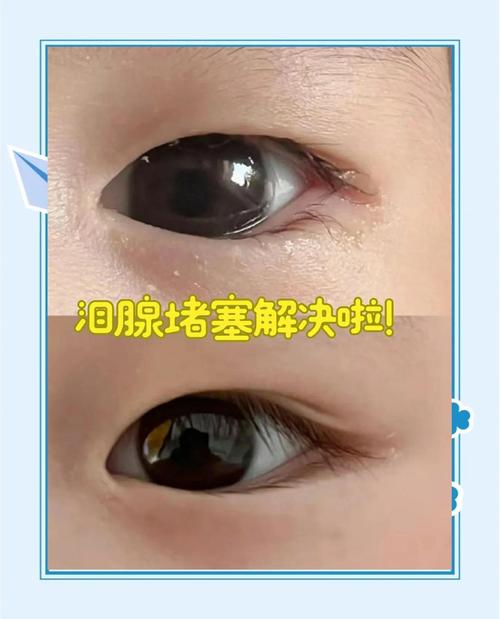 新生儿鼻泪管不通有哪些典型症状?家长该如何判断和处理?-第1张图片-郑州医学网 新生儿鼻泪管不通有哪些典型症状?家长该如何判断和处理?-第1张图片-郑州医学网