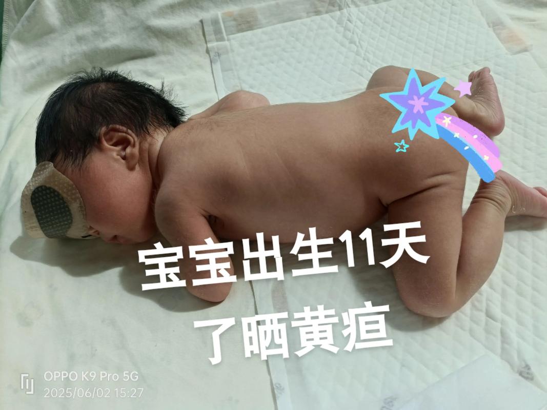 新生儿黄疸会出现哪些具体症状？不同症状如何区分生理性与病理性？-第2张图片-郑州医学网