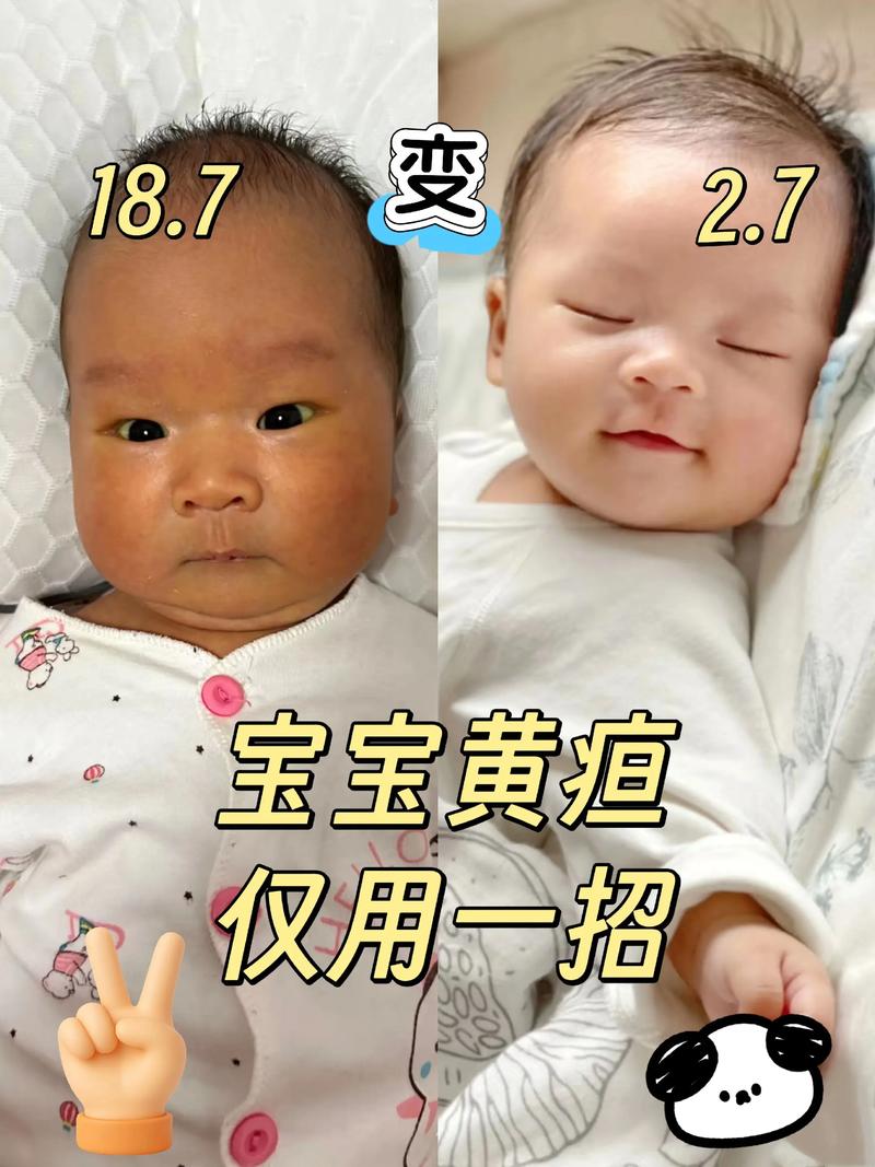 新生儿黄疸会出现哪些具体症状？不同症状如何区分生理性与病理性？-第3张图片-郑州医学网