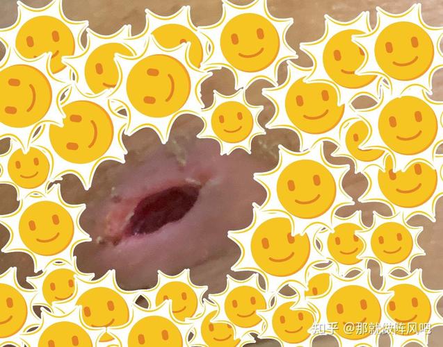 孕期屁股上突然长肉球,是痔疮还是其他危险信号?-第1张图片-郑州医学网 孕期屁股上突然长肉球,是痔疮还是其他危险信号?-第1张图片-郑州医学网