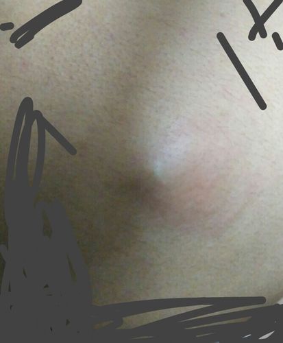 孕期屁股上突然长肉球,是痔疮还是其他危险信号?-第3张图片-郑州医学网 孕期屁股上突然长肉球,是痔疮还是其他危险信号?-第3张图片-郑州医学网