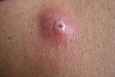 孕期屁股上突然长肉球,是痔疮还是其他危险信号?-第2张图片-郑州医学网 孕期屁股上突然长肉球,是痔疮还是其他危险信号?-第2张图片-郑州医学网