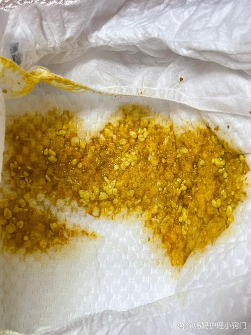 新生儿大便出现颗粒状奶瓣是消化不良还是正常现象?-第1张图片-郑州医学网 新生儿大便出现颗粒状奶瓣是消化不良还是正常现象?-第1张图片-郑州医学网