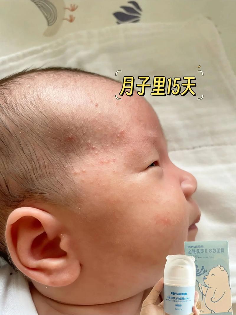 新生儿脸上起痱子，红痒哭闹不停，该怎么快速缓解护理？-第3张图片-郑州医学网