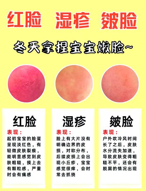 新生儿脸上起痱子，红痒哭闹不停，该怎么快速缓解护理？-第1张图片-郑州医学网