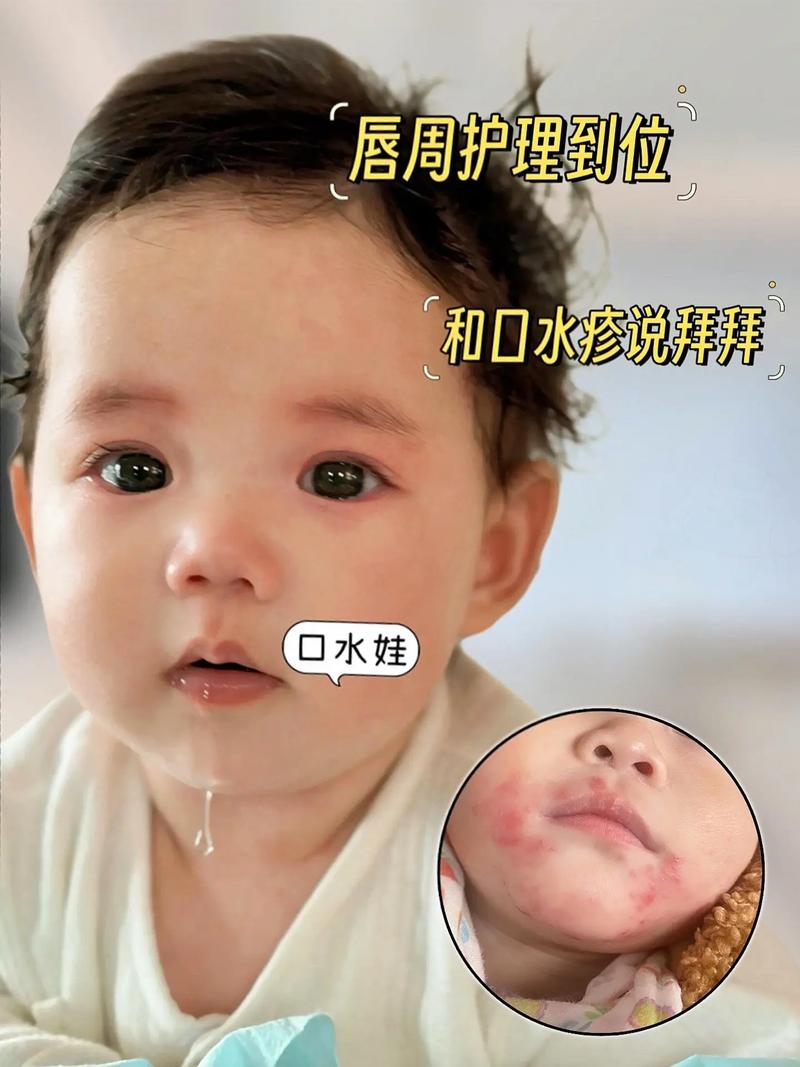 不到1个月新生儿总流口水是正常现象还是异常信号？-第3张图片-郑州医学网