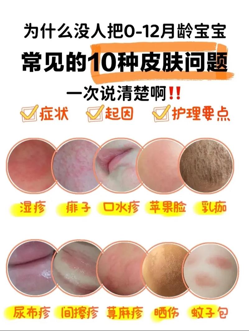 新生儿湿疹流黄水是感染了吗？该怎么护理处理？-第2张图片-郑州医学网