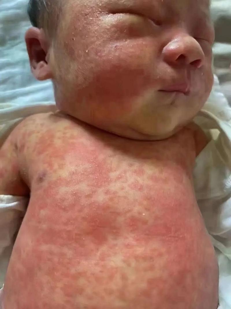新生儿脸上身上出现小红点是什么原因?需要担心吗?-第1张图片-郑州医学网 新生儿脸上身上出现小红点是什么原因?需要担心吗?-第1张图片-郑州医学网
