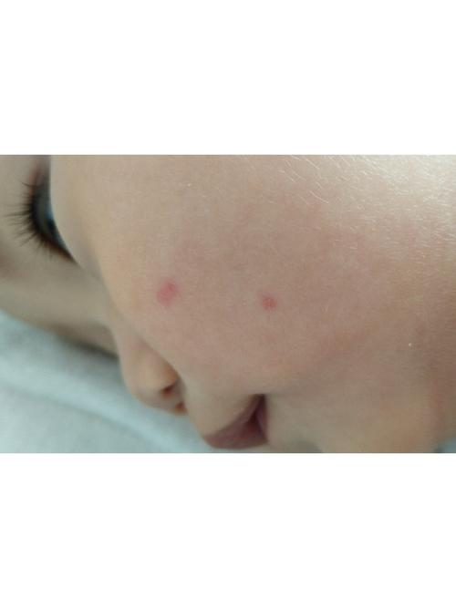 新生儿脸上身上出现小红点是什么原因?需要担心吗?-第3张图片-郑州医学网 新生儿脸上身上出现小红点是什么原因?需要担心吗?-第3张图片-郑州医学网