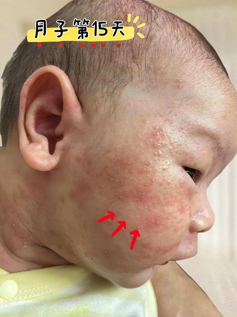 新生儿脸上身上出现小红点是什么原因?需要担心吗?-第2张图片-郑州医学网 新生儿脸上身上出现小红点是什么原因?需要担心吗?-第2张图片-郑州医学网