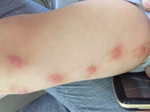 儿童海鲜过敏症状图片有哪些？如何辨别严重过敏反应？-第1张图片-郑州医学网