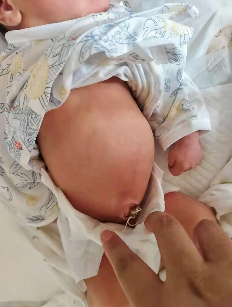 15天新生儿肚子鼓鼓的,是正常生理现象还是需要警惕的异常信号?-第3张图片-郑州医学网 15天新生儿肚子鼓鼓的,是正常生理现象还是需要警惕的异常信号?-第3张图片-郑州医学网