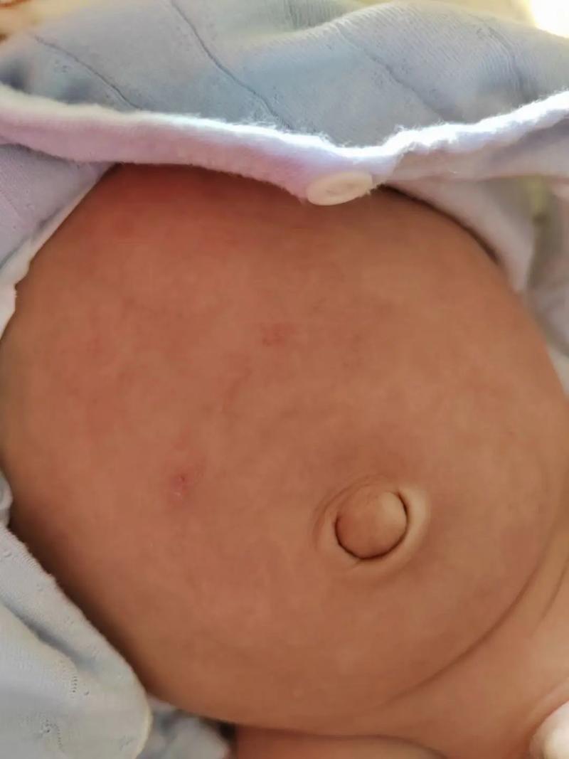 15天新生儿肚子鼓鼓的,是正常生理现象还是需要警惕的异常信号?-第1张图片-郑州医学网 15天新生儿肚子鼓鼓的,是正常生理现象还是需要警惕的异常信号?-第1张图片-郑州医学网