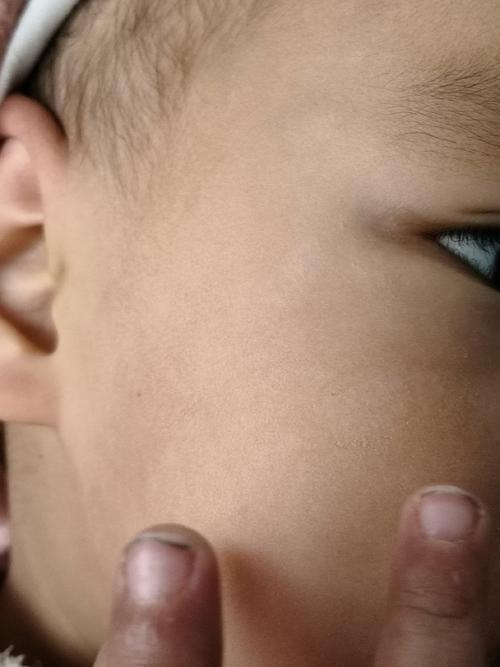 儿童面部白色糠疹白斑是缺钙还是皮肤病?需要治疗吗?-第2张图片-郑州医学网 儿童面部白色糠疹白斑是缺钙还是皮肤病?需要治疗吗?-第2张图片-郑州医学网