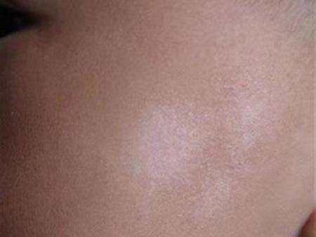 儿童面部白色糠疹白斑是缺钙还是皮肤病?需要治疗吗?-第3张图片-郑州医学网 儿童面部白色糠疹白斑是缺钙还是皮肤病?需要治疗吗?-第3张图片-郑州医学网