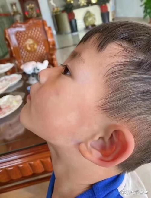 儿童面部白色糠疹白斑是缺钙还是皮肤病?需要治疗吗?-第1张图片-郑州医学网 儿童面部白色糠疹白斑是缺钙还是皮肤病?需要治疗吗?-第1张图片-郑州医学网