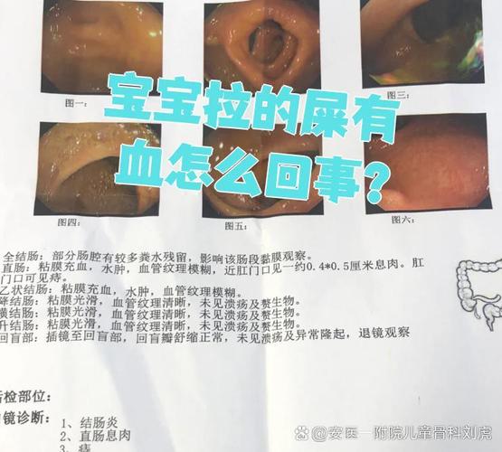 新生儿拉便血是哪些疾病信号?家长该如何紧急处理?-第2张图片-郑州医学网 新生儿拉便血是哪些疾病信号?家长该如何紧急处理?-第2张图片-郑州医学网