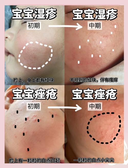 新生儿眼角湿疹反复发作，日常护理与用药该如何正确处理？-第2张图片-郑州医学网