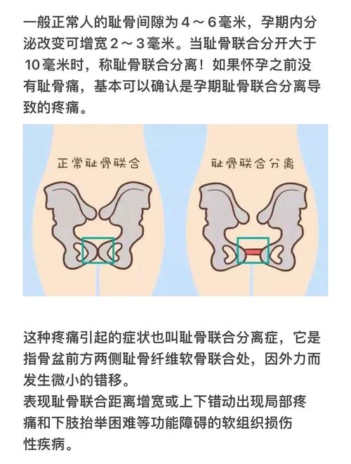 孕期骨缝疼是正常生理反应还是异常信号？原因与缓解方法是什么？-第3张图片-郑州医学网