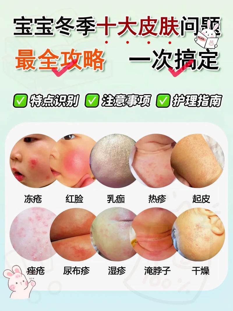 新生儿湿疹不严重需要干预吗？日常护理要注意哪些细节才能缓解？-第2张图片-郑州医学网