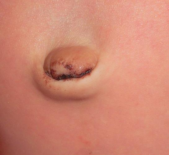 新生儿肚脐脱落后有血痂,是正常现象还是需要特殊处理?-第1张图片-郑州医学网 新生儿肚脐脱落后有血痂,是正常现象还是需要特殊处理?-第1张图片-郑州医学网