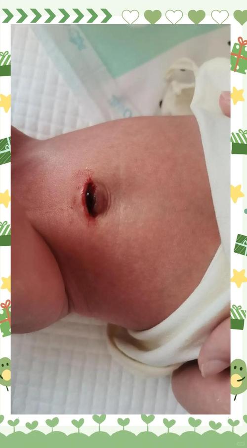 新生儿肚脐脱落后有血痂，是正常现象还是需要特殊处理？-第2张图片-郑州医学网