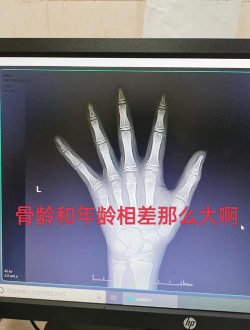 儿童骨折拍片辐射危害有多大？家长该如何科学防护？-第2张图片-郑州医学网