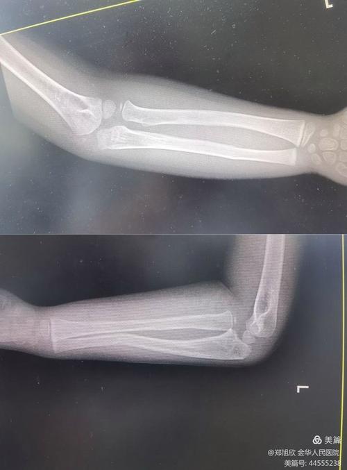 儿童骨折拍片辐射危害有多大?家长该如何科学防护?-第1张图片-郑州医学网 儿童骨折拍片辐射危害有多大?家长该如何科学防护?-第1张图片-郑州医学网