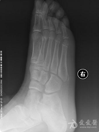 儿童第五跖骨突出是正常生理现象还是病理性异常?附图片解析与应对建议-第2张图片-郑州医学网 儿童第五跖骨突出是正常生理现象还是病理性异常?附图片解析与应对建议-第2张图片-郑州医学网